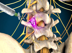 Medial Injection Medial Branch Injections - Advanced PainCare, Dr. Michael Fishell